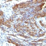 Formalin-fixed, paraffin embedded human uterus sections stained with 100 ul anti-Caldesmon, HMW (clone CALD1/820) at 1:50. HIER epitope retrieval prior to staining was performed in 10mM Tris 1mM EDTA, pH 9.0.